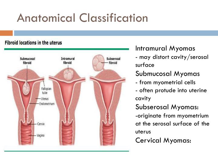 Intramural and Subserous Leiomyoma of Uterus