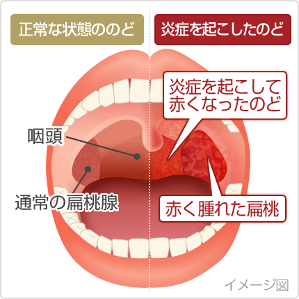 【画像あり】 朝起き たら 喉 が 痛い 衝撃の最新ニュース #919