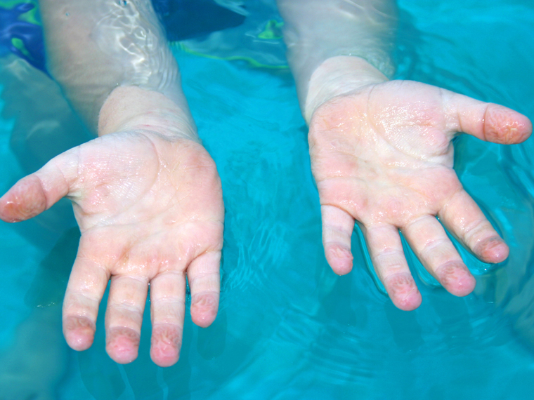 Why Does Skin Shrivel in Water