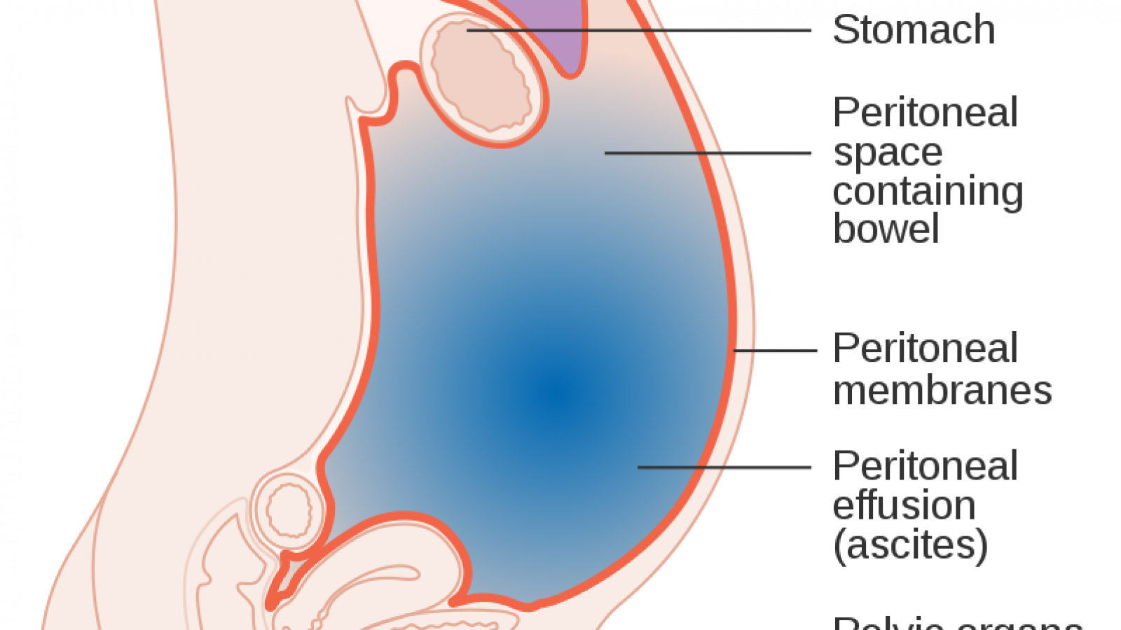 What Causes Fluid Build up in the Abdomen