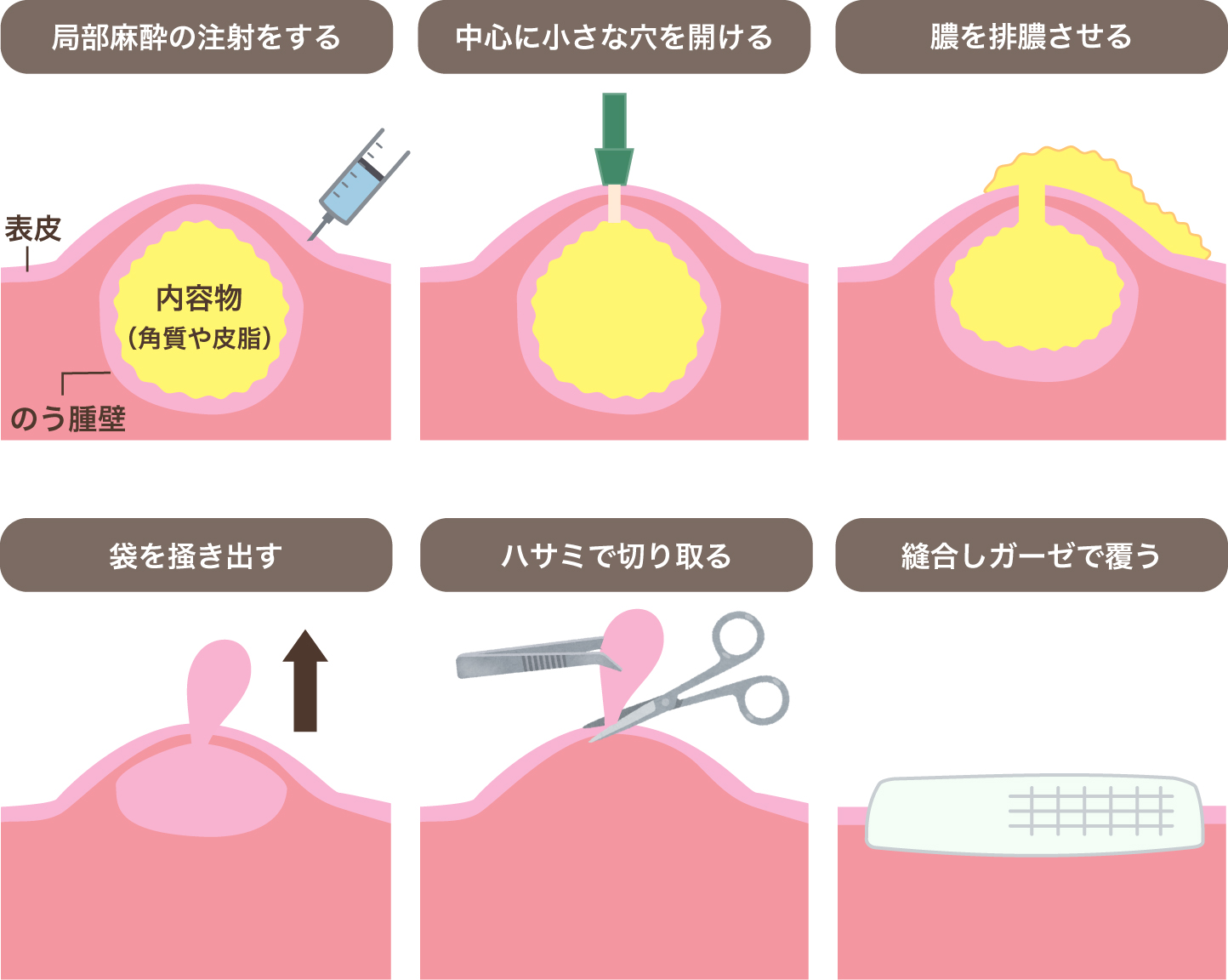 粉瘤手術は保険適用できる？費用相場とくり抜き法の傷跡を徹底検証