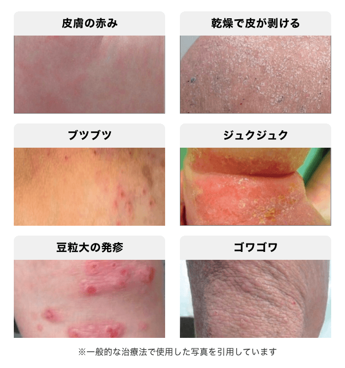 汗でアトピーがかゆい原因はカビ？マラセチアと汗の真実【2026】