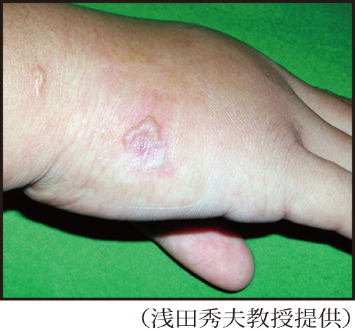 【2026年最新】猛暑が生んだ秋の死角：「蚊 アレルギー」急増の真相と命を守る防衛ライン