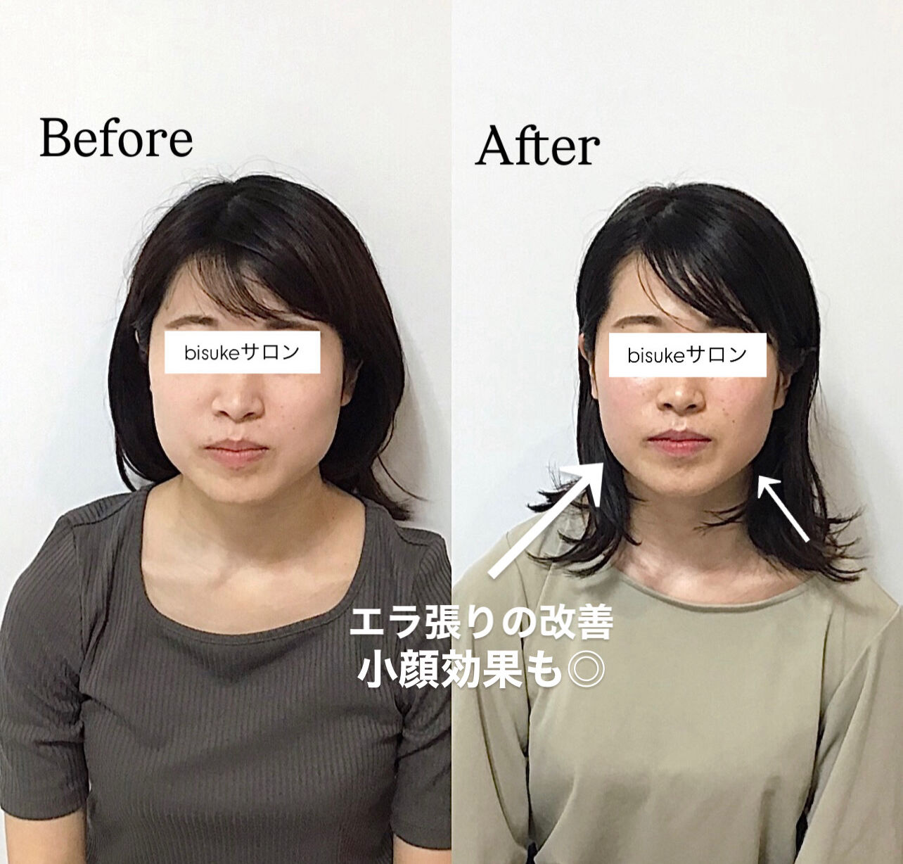 エラボトックス失敗の真相｜頬こけ・笑顔の違和感を防ぐプロの選び方