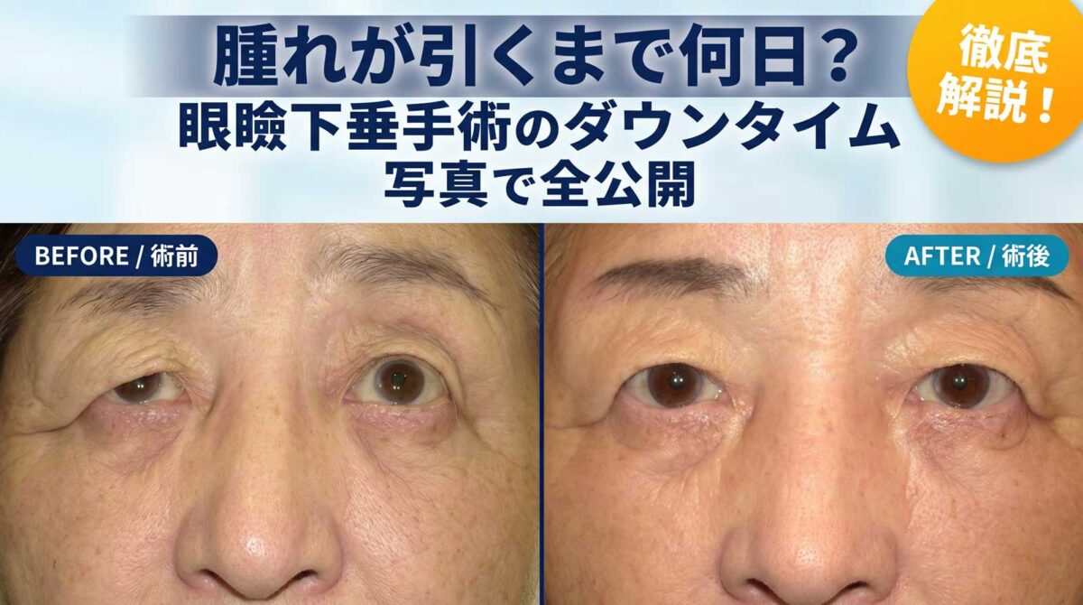 眼瞼下垂手術の腫れ写真はいつ引く？ピークと術後経過を徹底検証