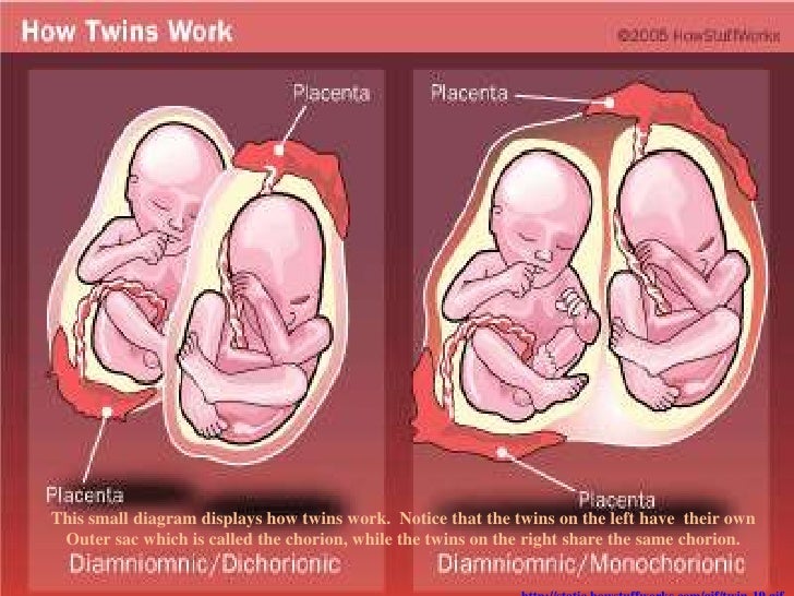 What Happens If One Twin Dies in the Womb