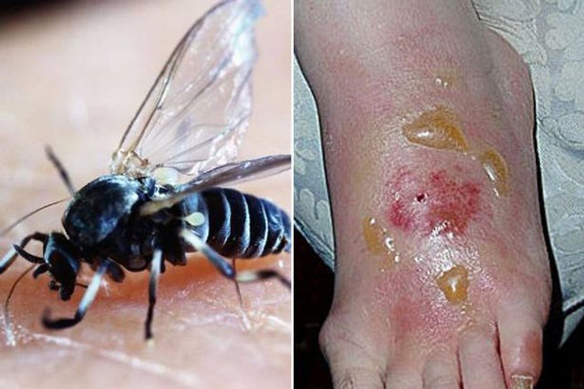 Why Are Blandford Fly Bites So Bad