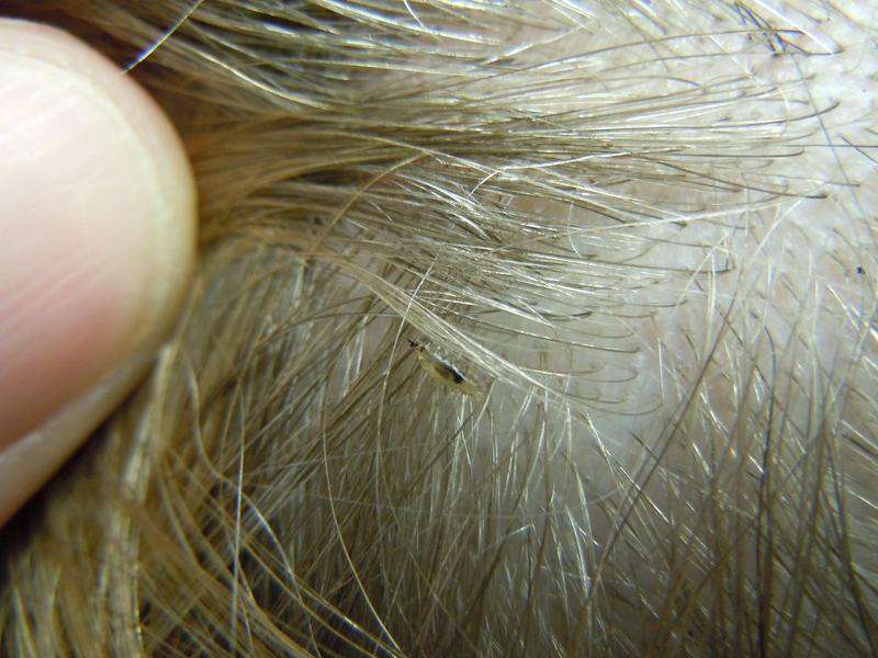 What Does Lice Look Like in Blonde Hair