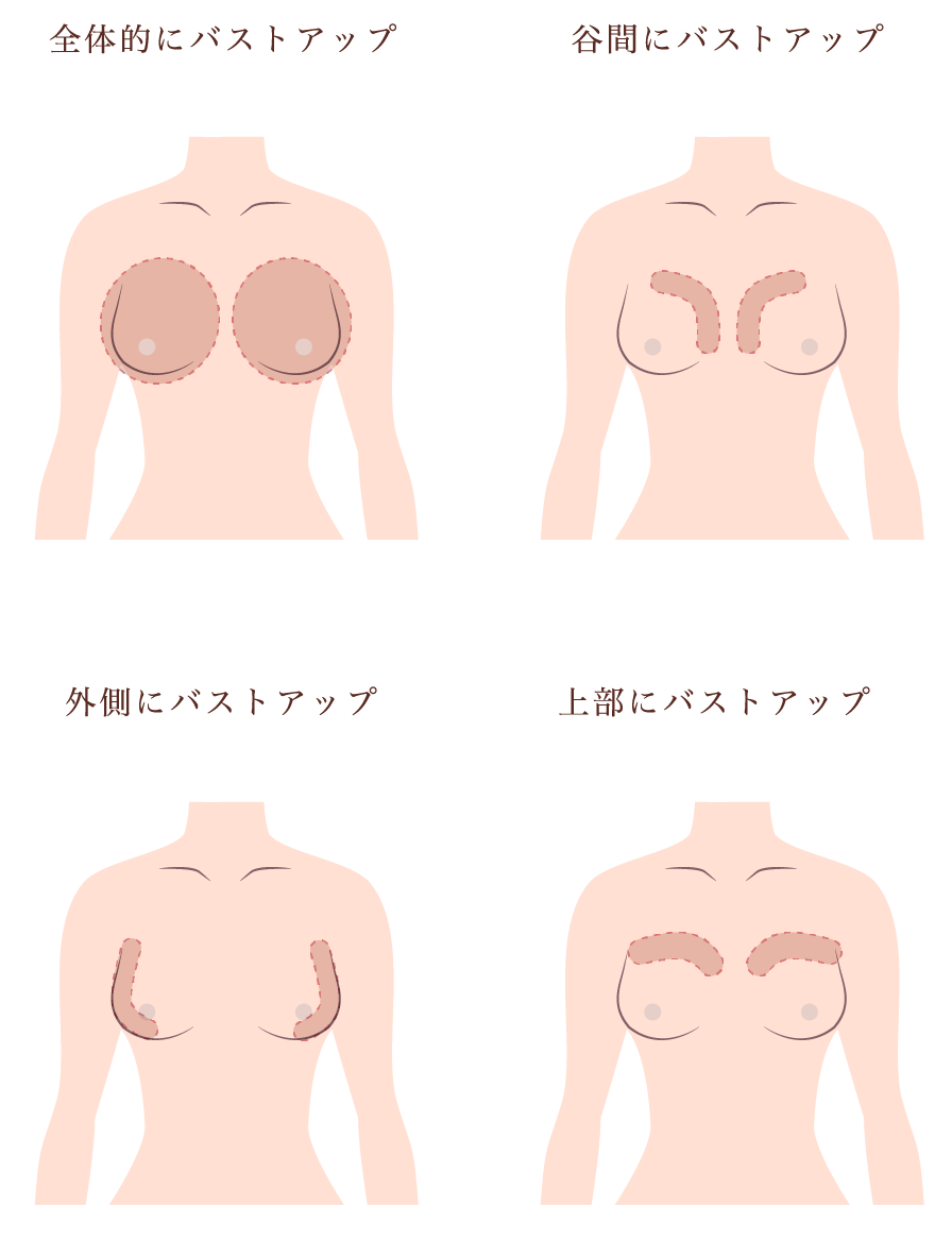 胸が小さくなった原因と再生術｜急激なバストダウンの真相と改善法