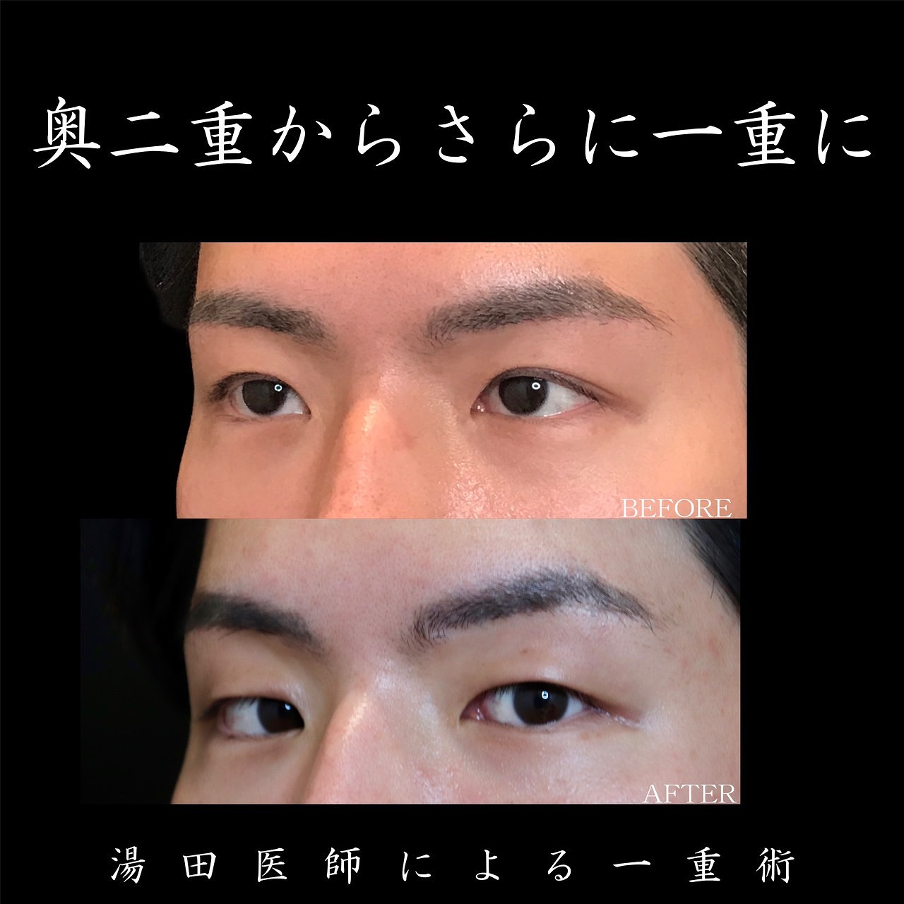 二重から一重になった原因は？急に消えたまぶたを戻す治し方と対策