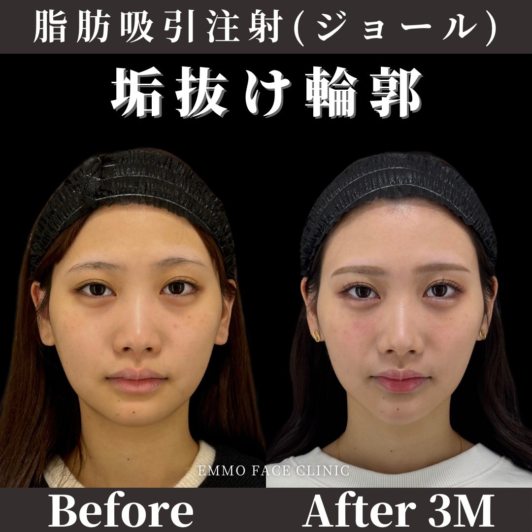 なぜ頬の肉だけ落ちない？原因別の即効解消法と2026年小顔施術の真実