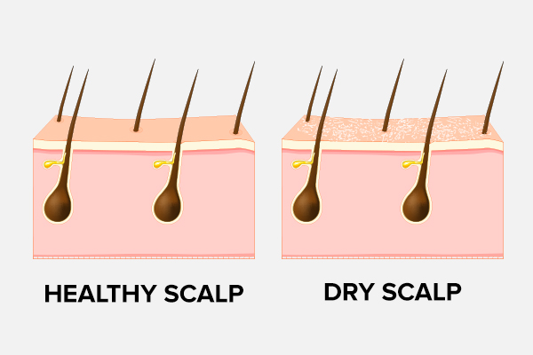 Why Is My Scalp Always Dry