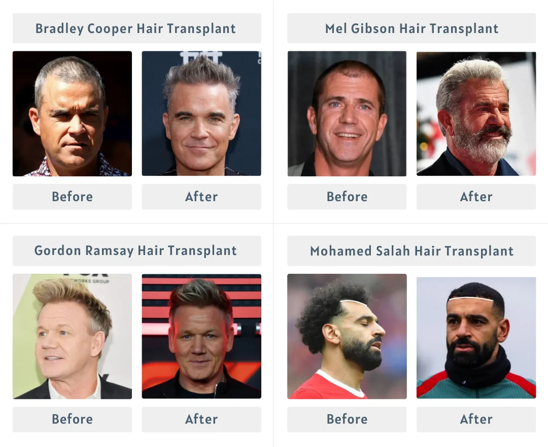 Stars Who Have Had Hair Transplants