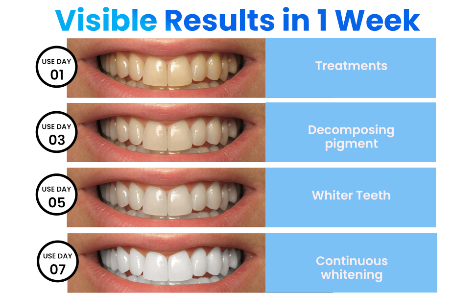 How Often Can You Use Teeth Whitening Strips