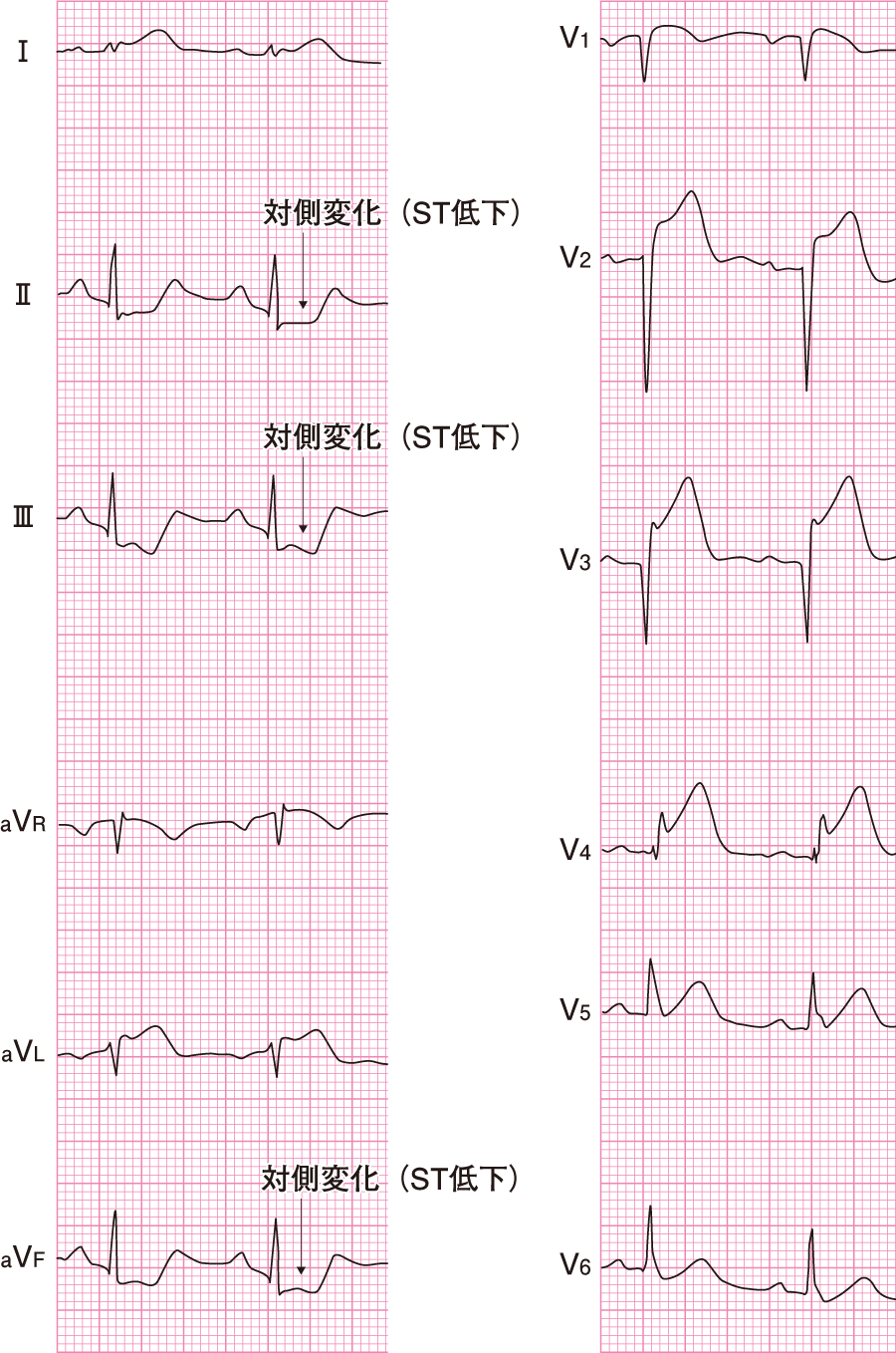 心電図の異常波形一覧と見分け方！危険なサインと緊急対応を徹底解説