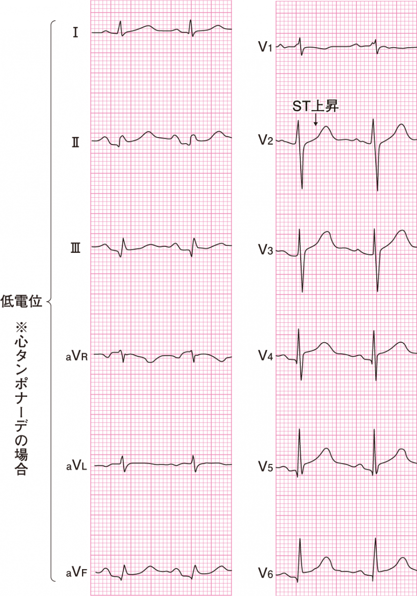心膜炎の心電図と心筋梗塞の違いとは？広範なSt上昇と鑑別の真相