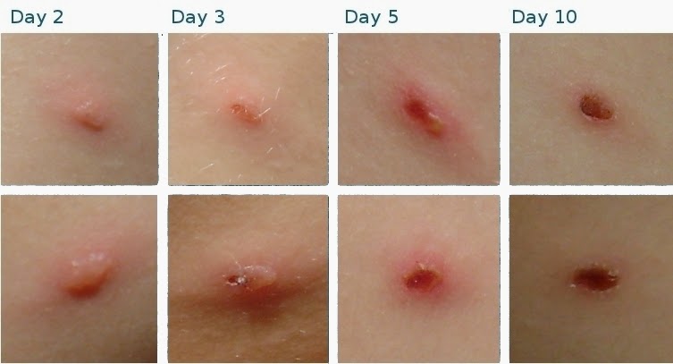 What Do Chickenpox Look Like in the Beginning