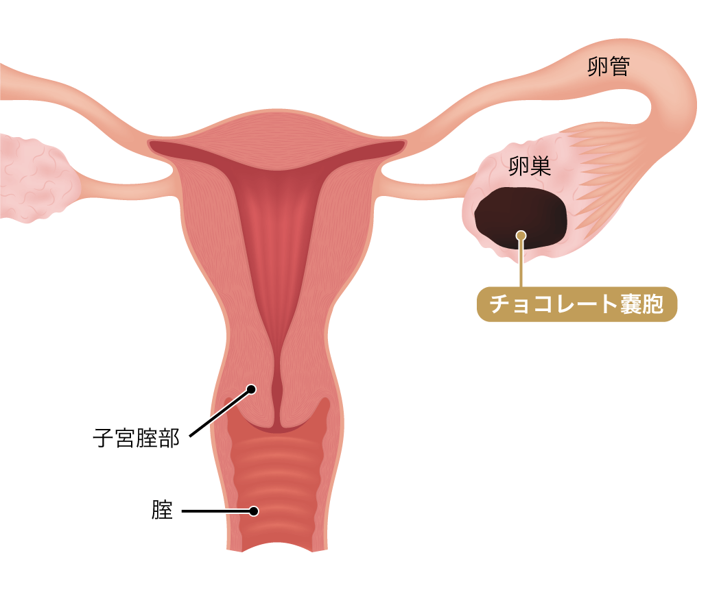 子宮内膜症チョコレート嚢胞の真相｜癌化リスク・手術基準と妊娠への影響