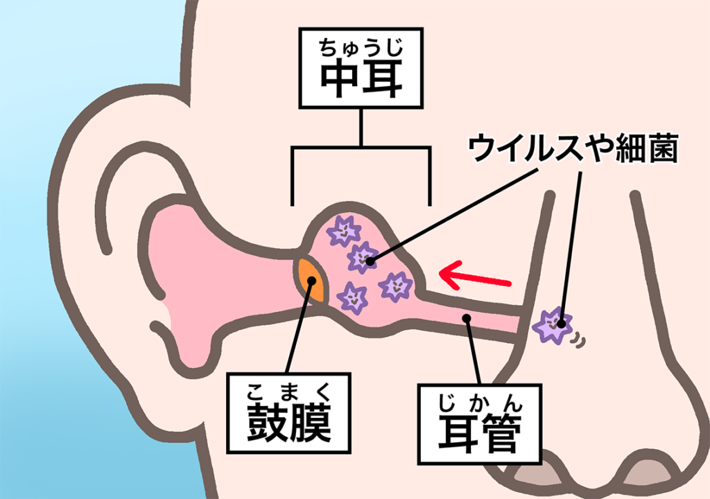 副鼻腔炎から中耳炎を併発する理由と耳の違和感を防ぐ最新知見