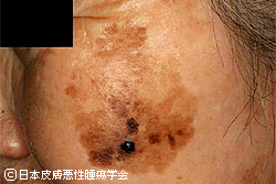 【Wiki風】 顔 が 黒い 病気 画像 人気理由と評判まとめ #725