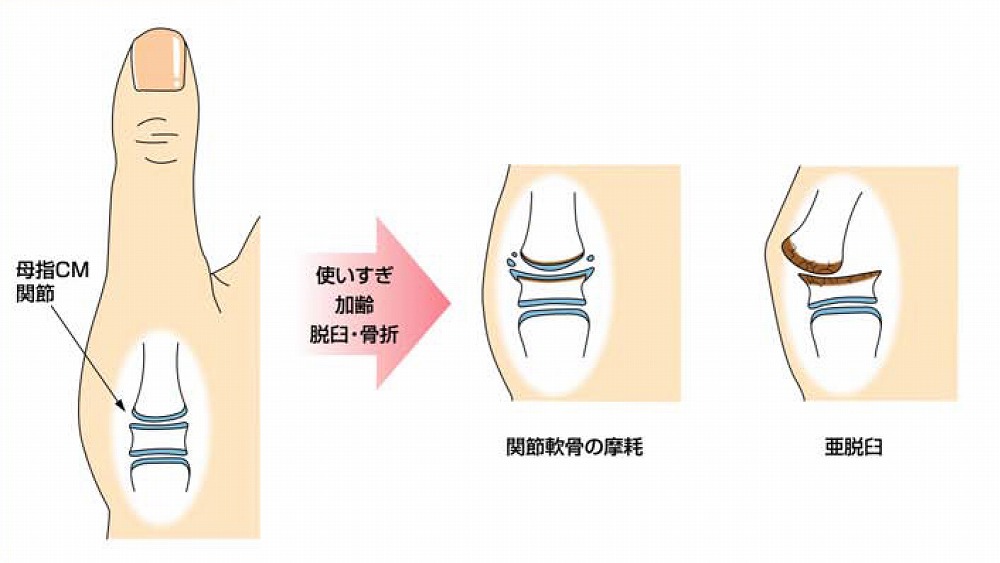 スマホで親指の第一関節が痛い？放置の危険性と医師が教える改善法