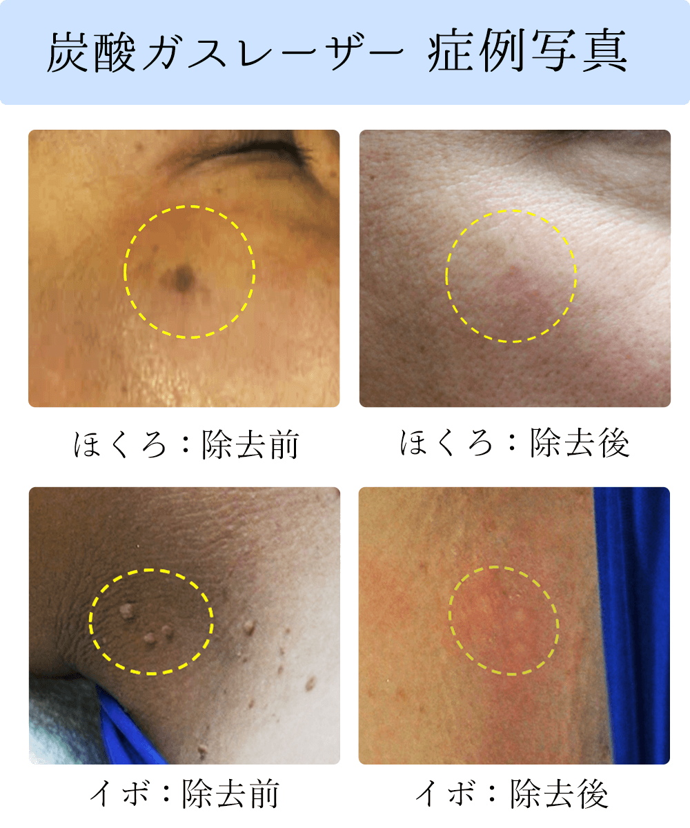 顔のイボの種類と見分け方写真比較！悪性腫瘍や2026年最新治療