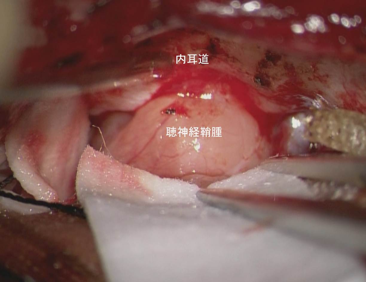 聴神経腫瘍の最新情報まとめ｜片耳難聴のサインと噂の真相に迫る