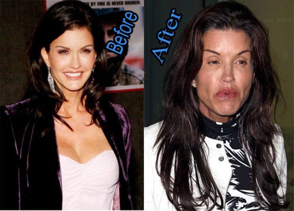 Celebs Before and After Plastic Surgery