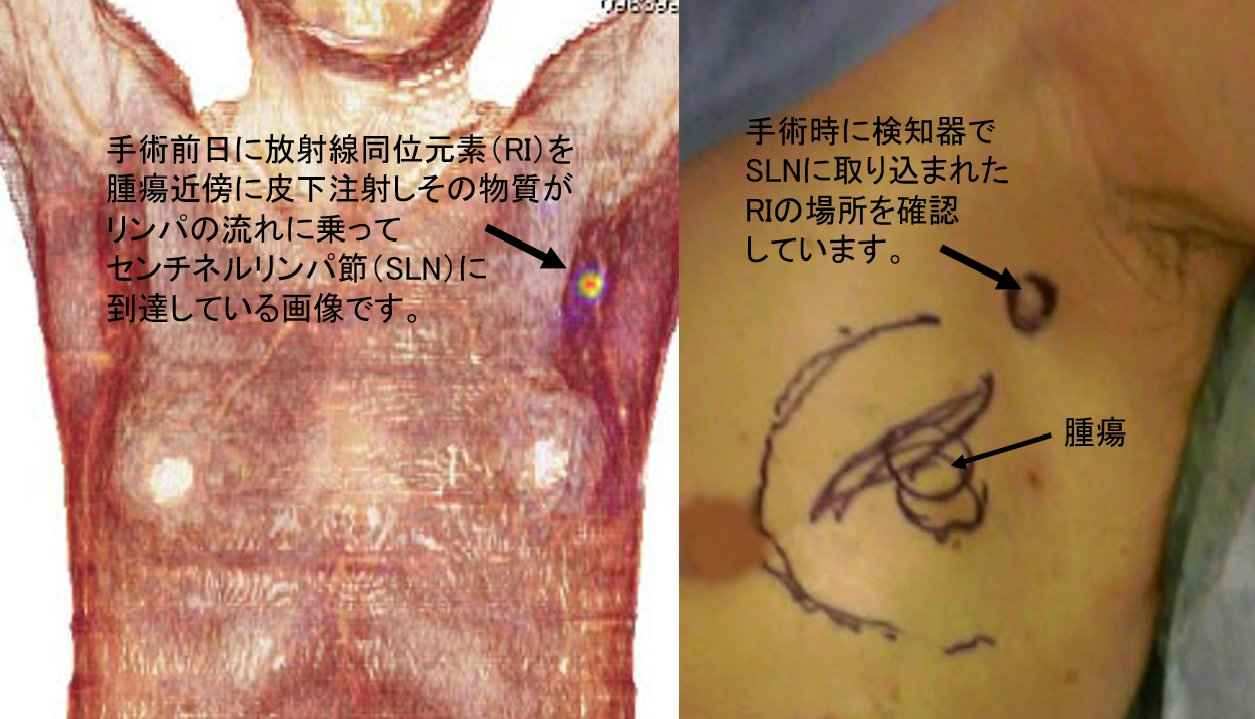 センチネルリンパ節生検とは？陽性時の治療と郭清省略の真実【2026】