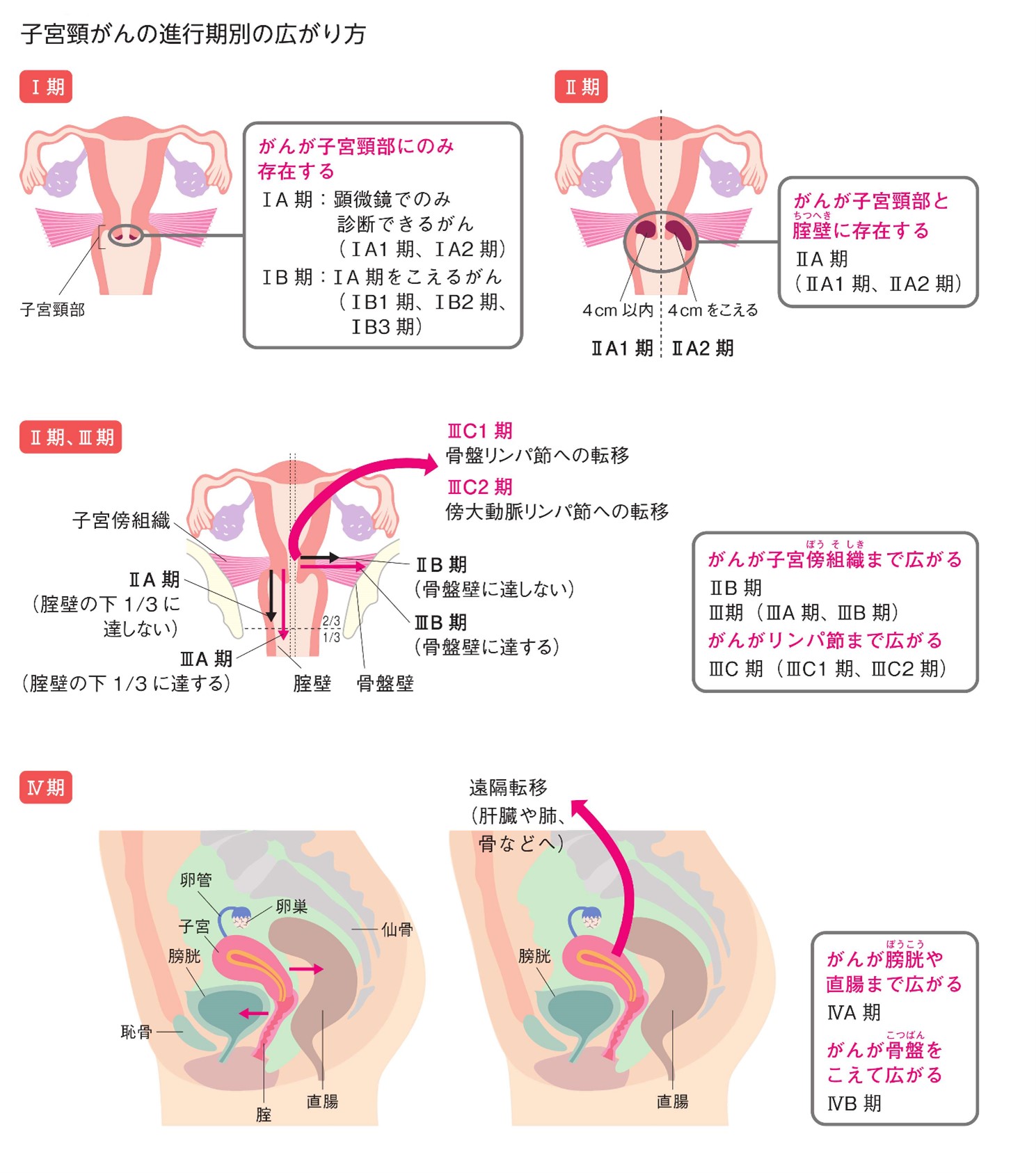 子宮頸がんの進行速度は年単位？初期症状とステージ別タイムラインを徹底解説