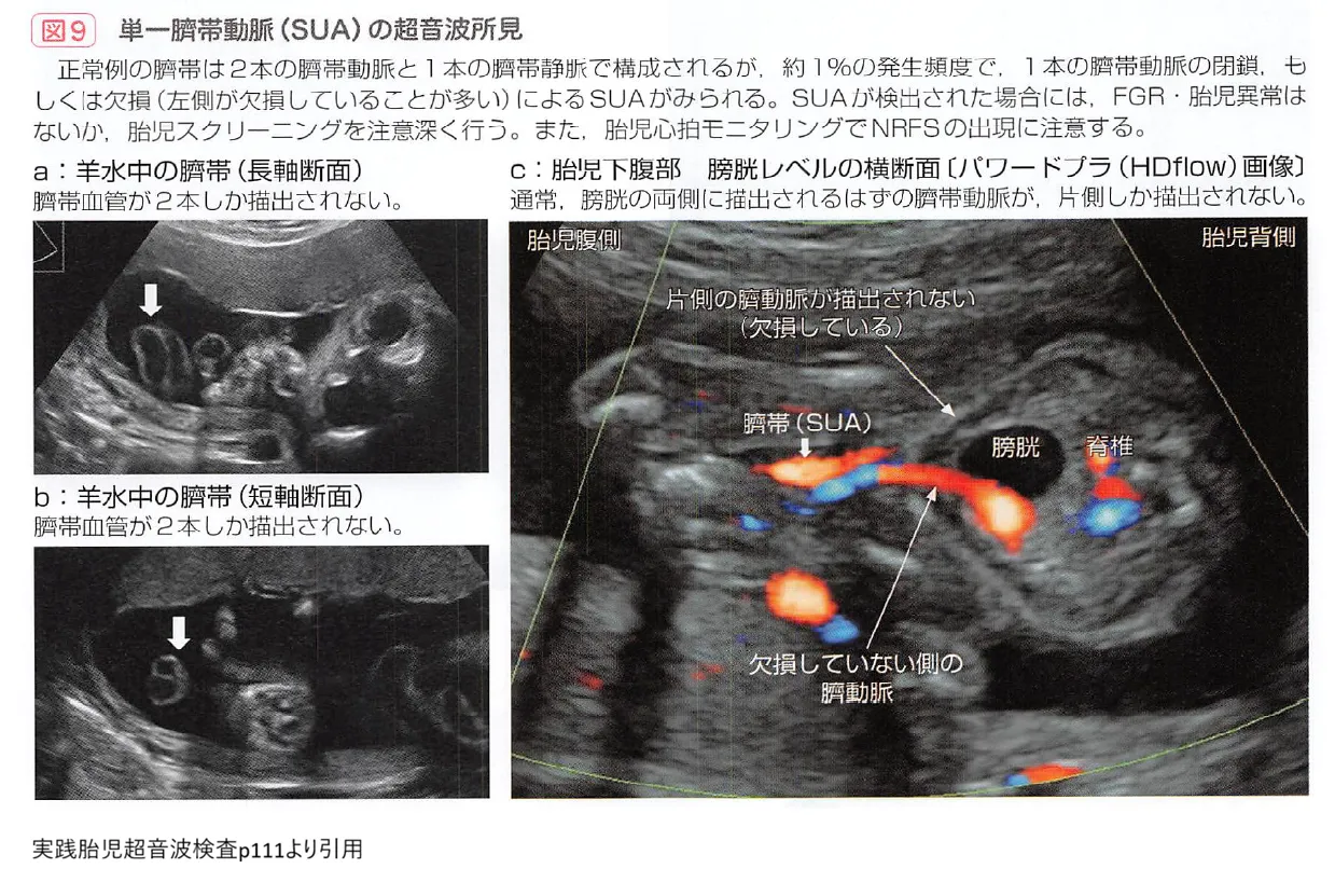 妊娠10週エコーでダウン症の特徴は判明する？首のむくみNtと鼻骨の真相