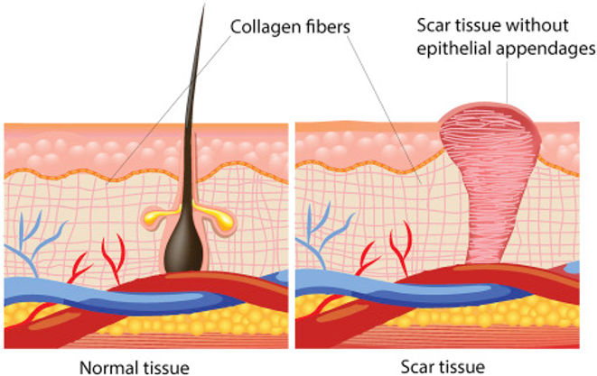 Does Scar Tissue Heal