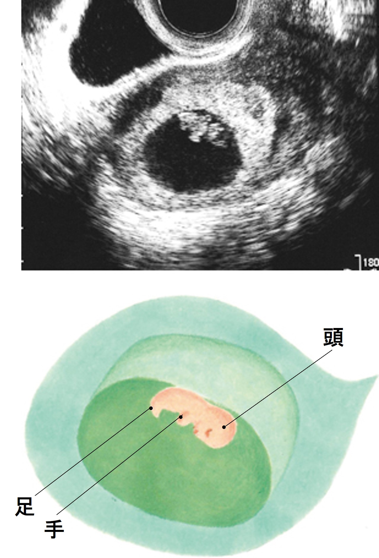 妊娠7週の壁を乗り越える｜心拍確認・つわりピークと流産不安の真実