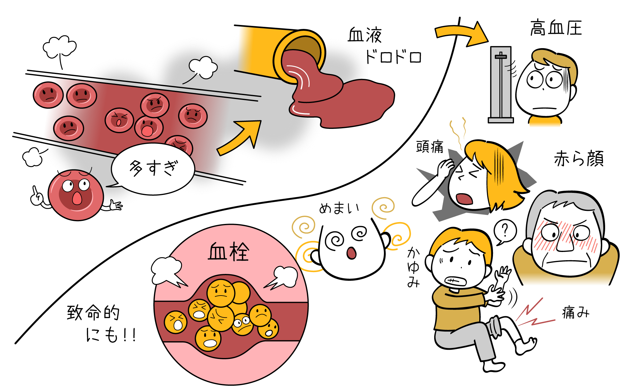 健診の多血症を放置するな！血液ドロドロの真相と脳梗塞リスク