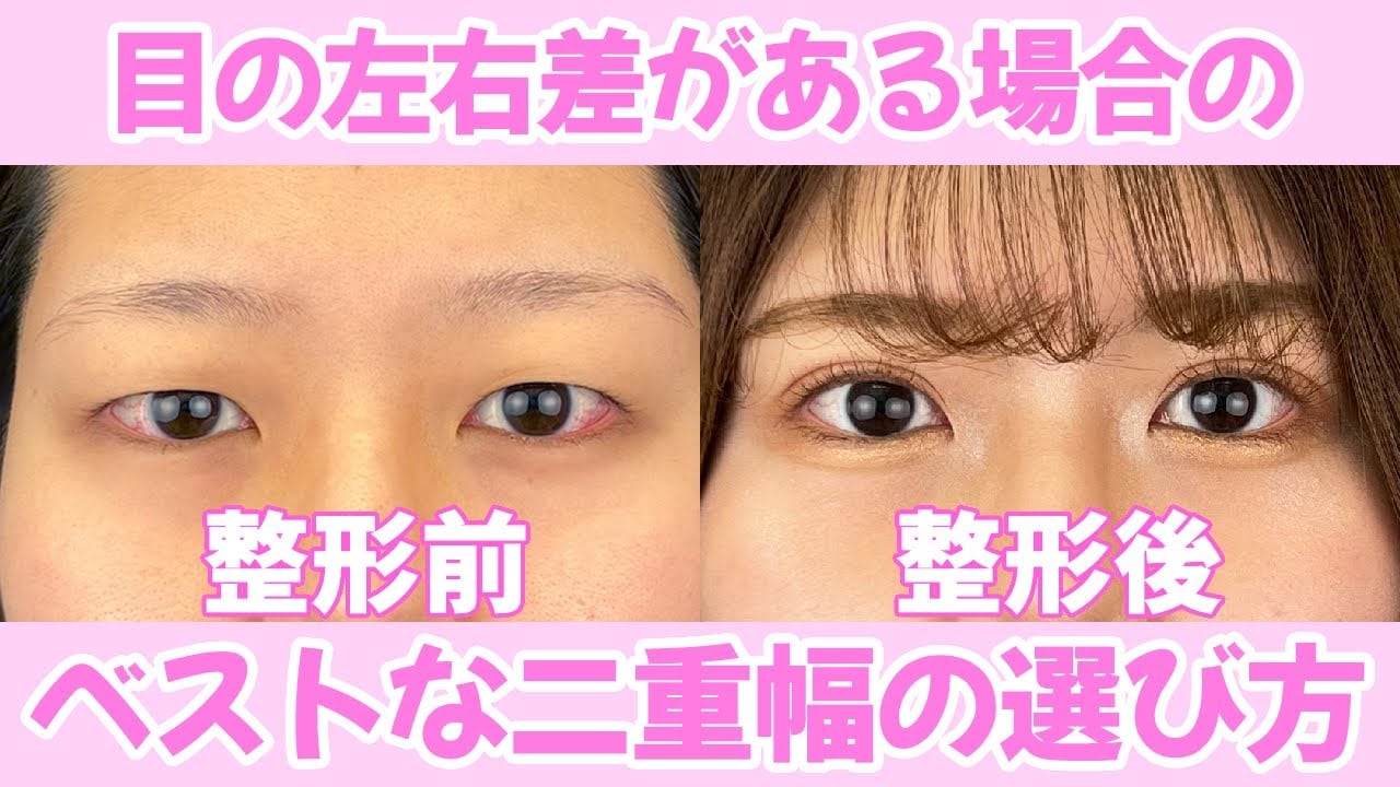 目が左右非対称な原因とは？自力ケア・メイク補正から眼瞼下垂まで徹底解説