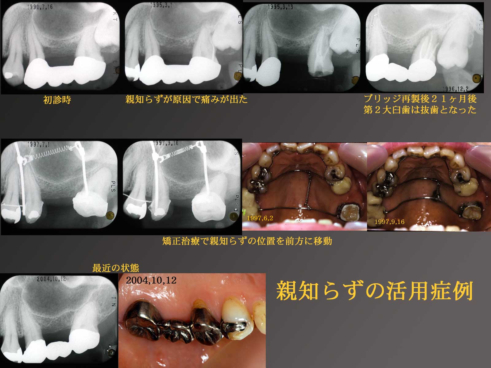 親知らず抜歯は地獄？なんJの激痛体験談とドライソケット回避の真相