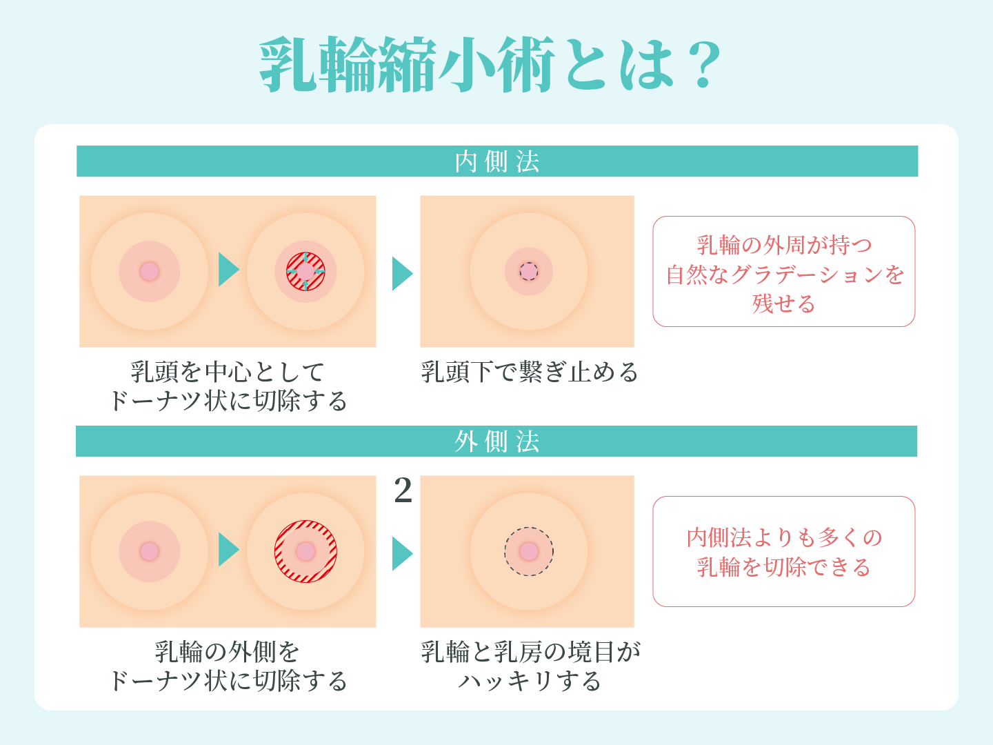 でかい乳輪の真実｜平均サイズ・肥大原因と最新縮小術の費用・男の本音