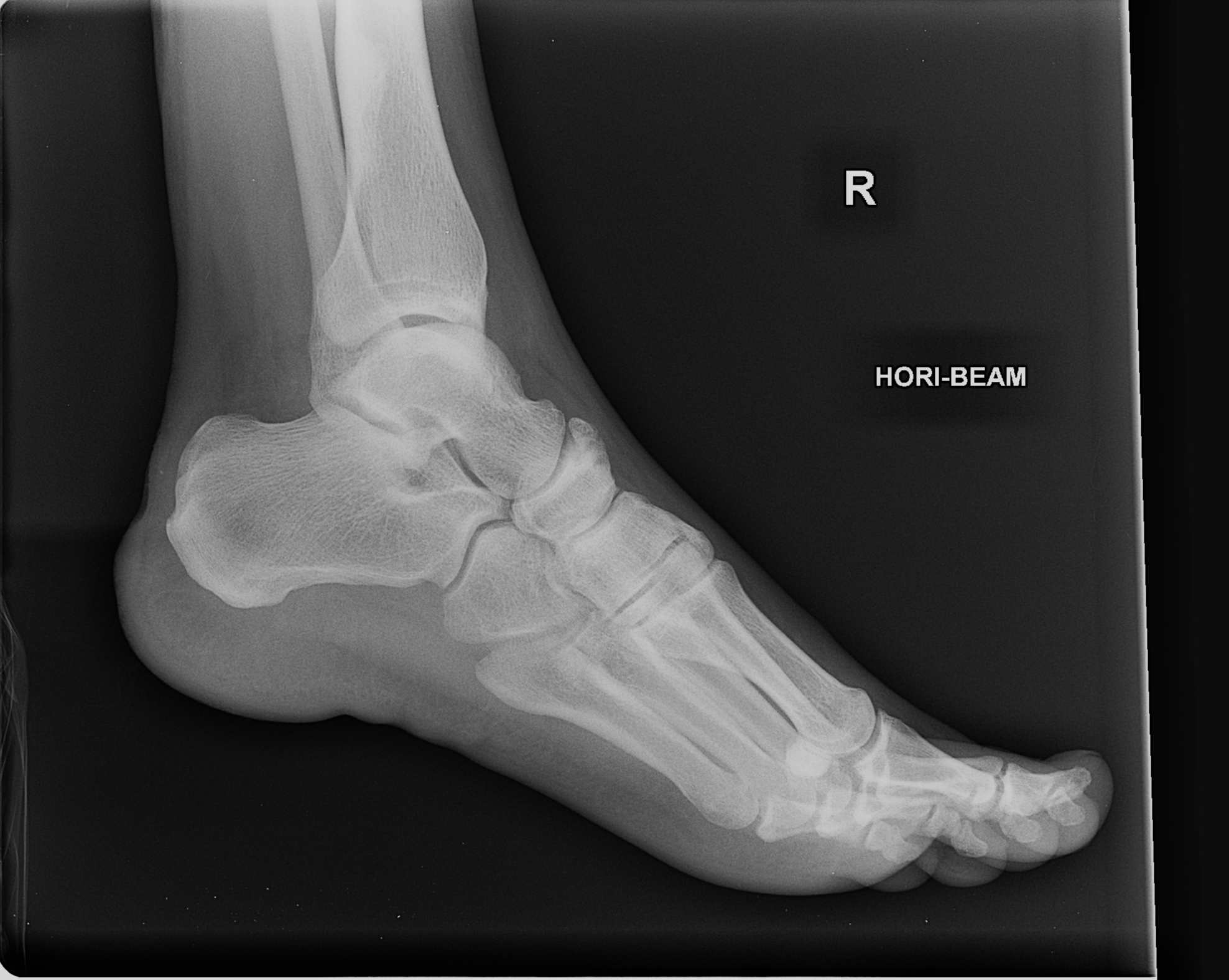 Normal X Ray of Ankle