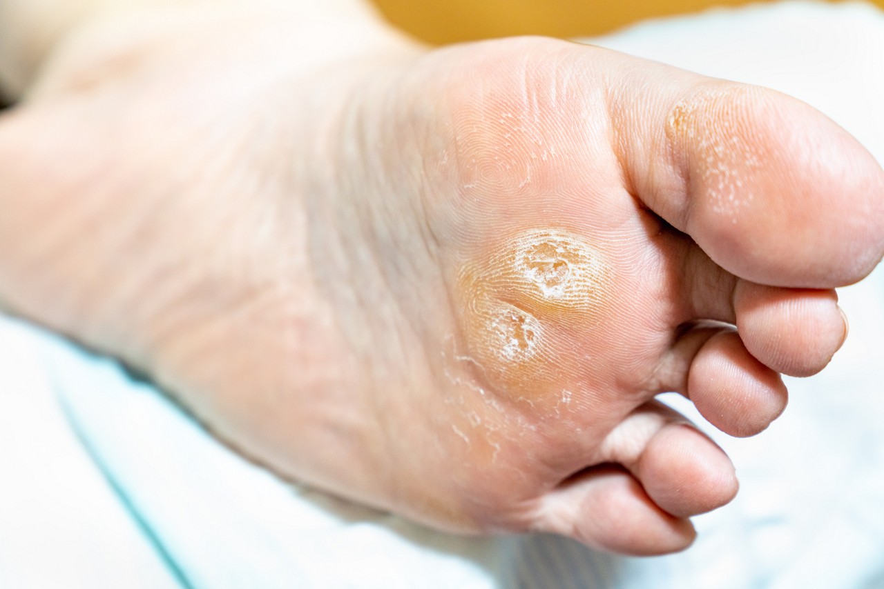 夏に足の皮がむける真相！水虫と汗疱の見分け方と2026年最新治療