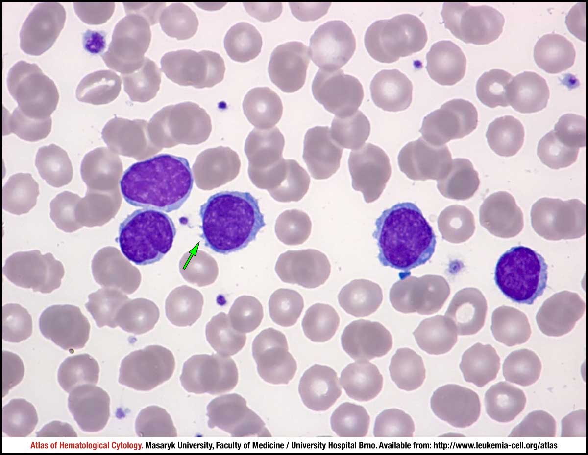 Malignant Lymphoid Cell Other Than Blast