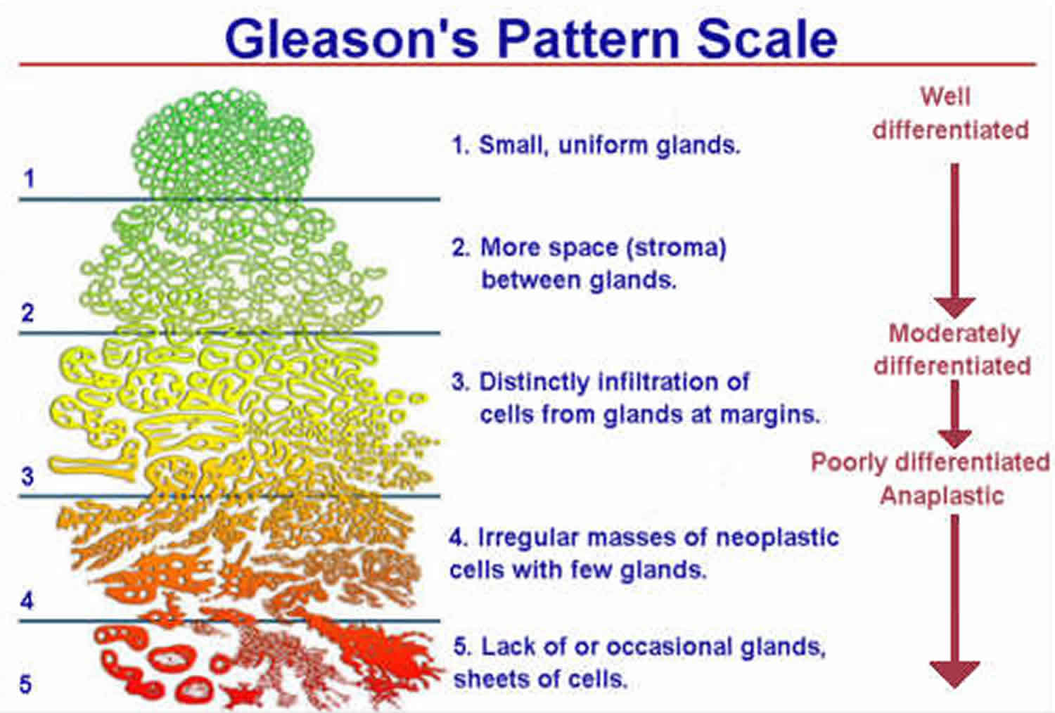 Adenocarcinoma Gleason Score 6