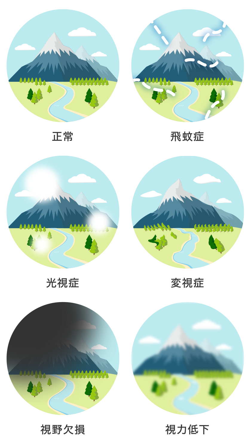 網膜剥離の見え方画像を完全再現！黒いカーテンや光視症の前兆と失明危機