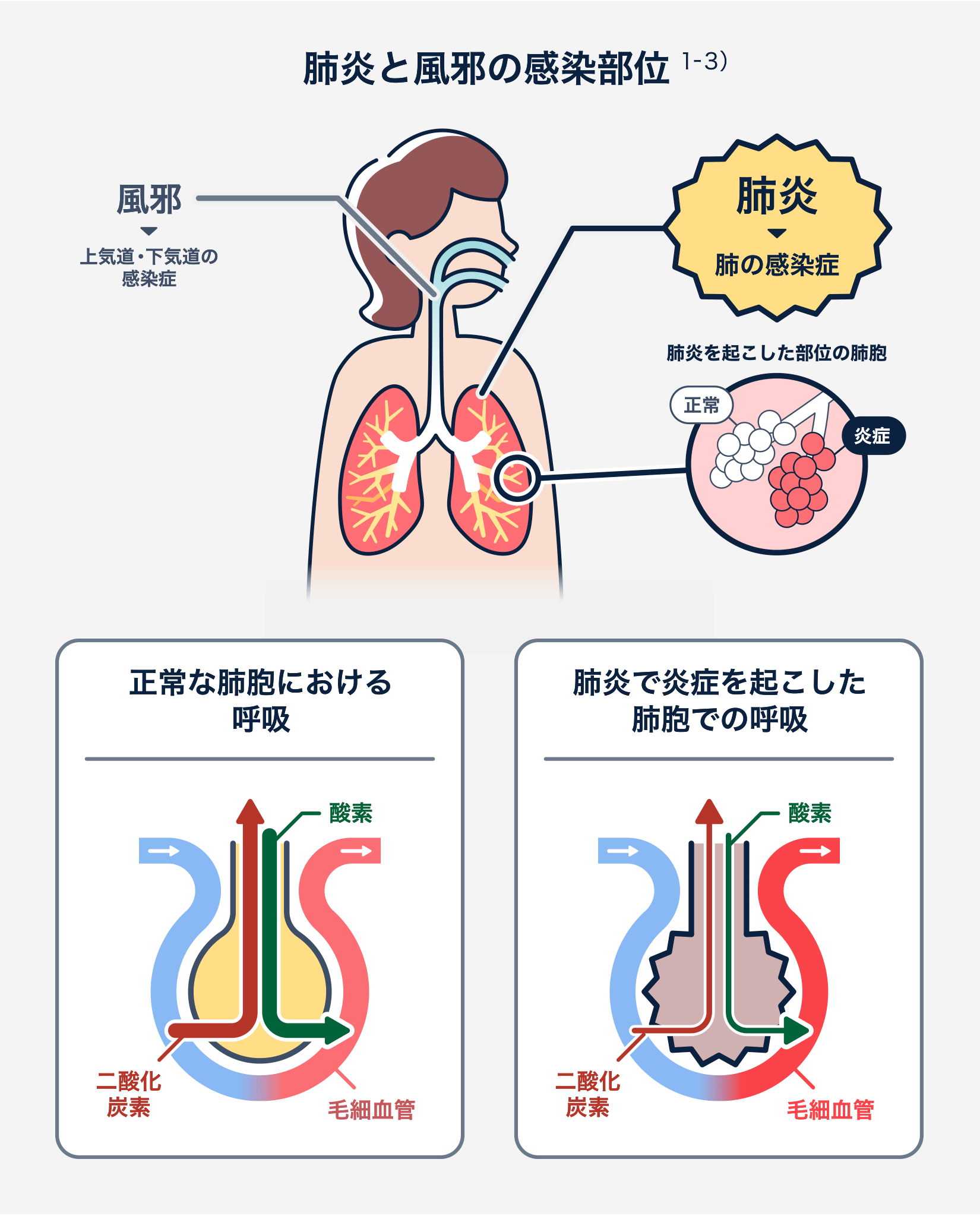 【2026年最新】新型肺炎の症状と風邪の違い・受診目安を徹底解説
