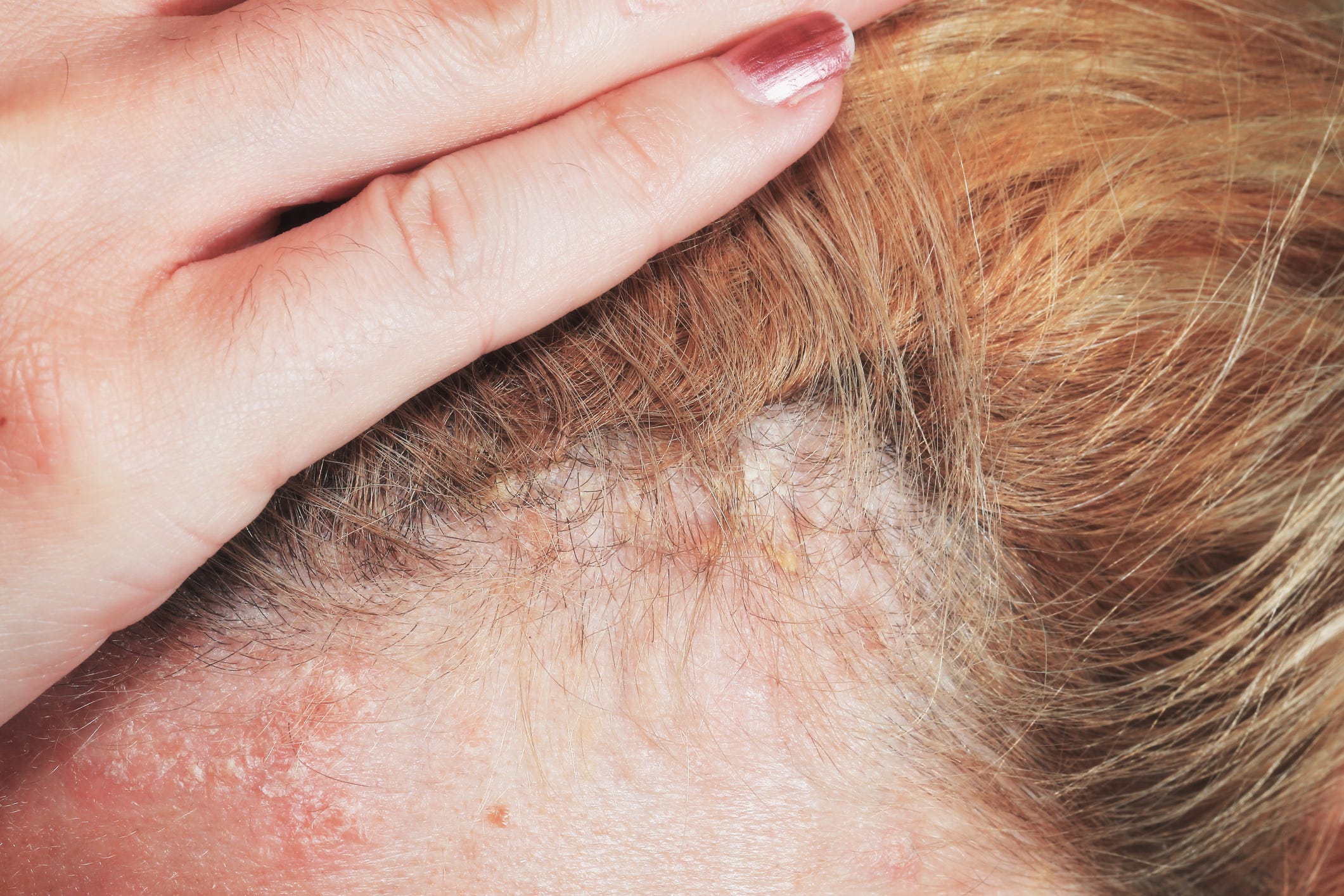 Why My Scalp Is Itchy and Flaky