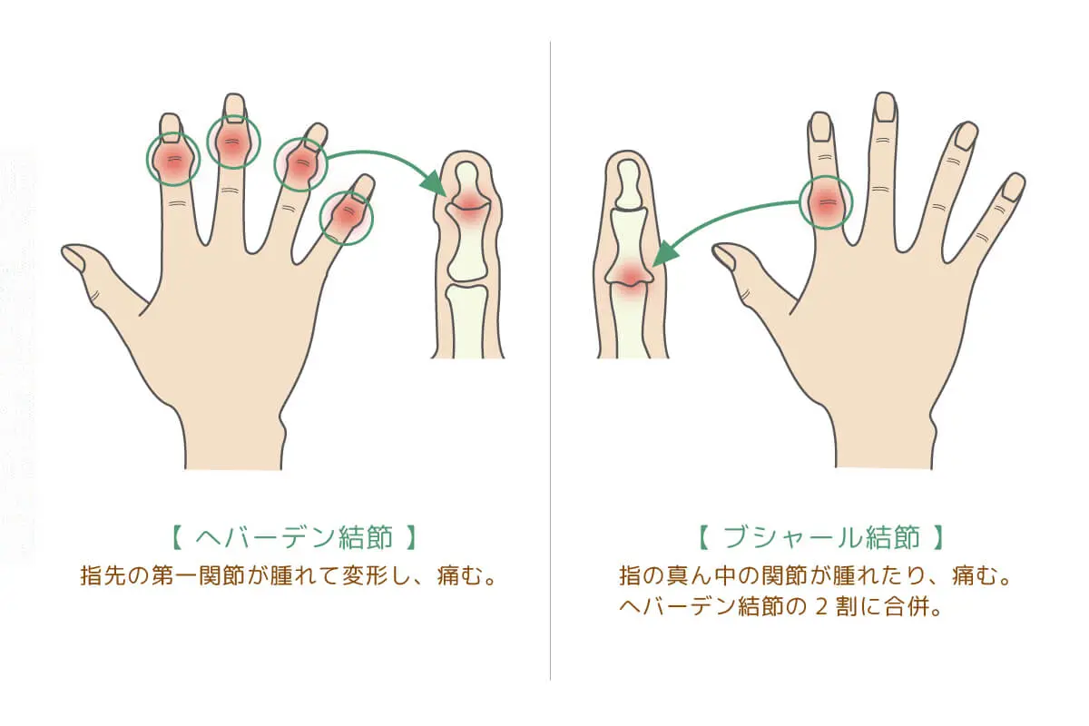 指の関節が太い原因と改善法！骨太や指鳴らしの真相を徹底究明