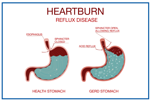 Heartburn After Drinking Water on Empty Stomach
