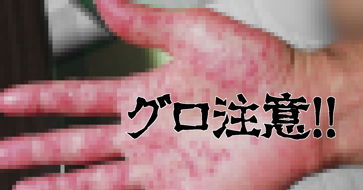 大人の手足口病写真と初期症状！子供より激痛で重症化する理由と経過