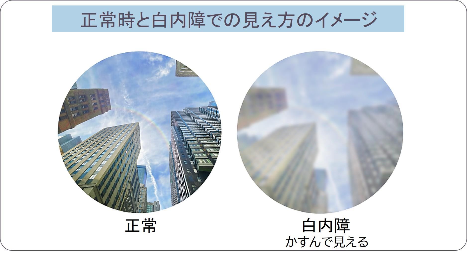 白内障と緑内障の違いを徹底解剖！失明リスクと見え方の真相【2026】