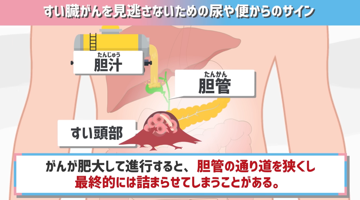 膵臓がん初期のわずかな前兆と早期発見の鍵を徹底解説