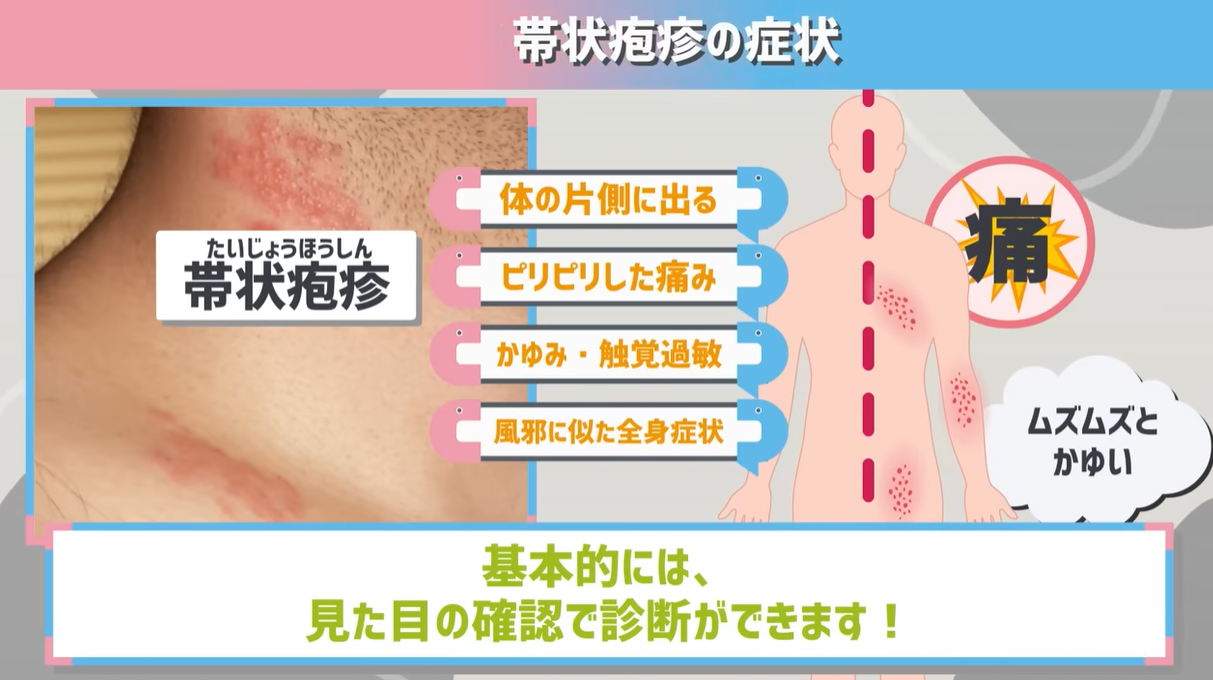 帯状疱疹がうつる期間はいつまで？感染経路と仕事休む目安の真相